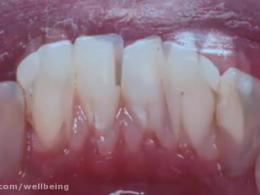 علت تغییر رنگ دندان و درمان آن