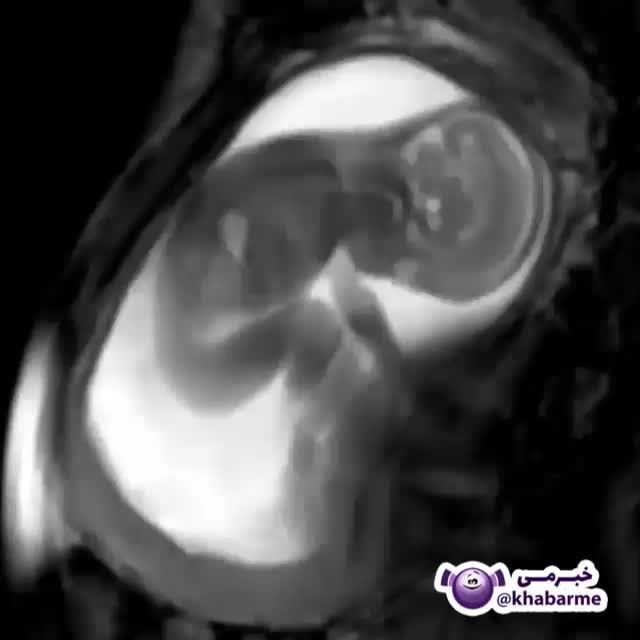 تصویری بسیار جالب از یک جنین در هفته های آخر بارداری در رحم مادر 